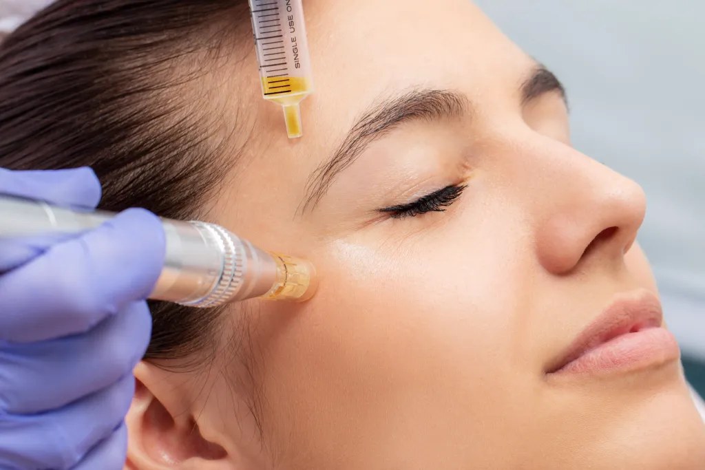 prpmicroneedling-1024x683